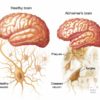 Alzheimer's Cognoscopy Lab Test