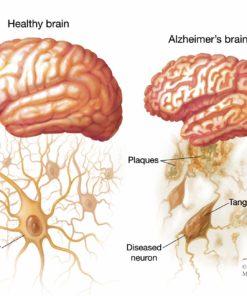 Alzheimer's Cognoscopy Lab Test