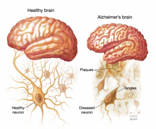 Alzheimer's Cognoscopy Lab Test