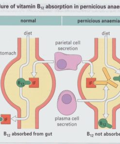 pernicious anemia