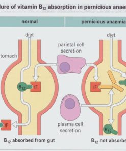 pernicious anemia