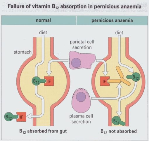 pernicious anemia