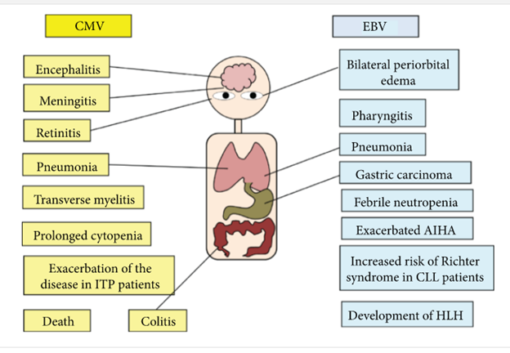 epstein barr virus symptoms